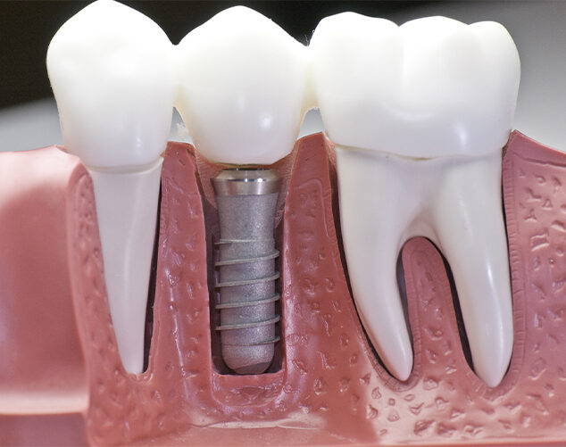 dental implant model showing implant treatment