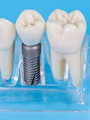 Why Choose Royal West Dentistry for Your Dental Implants?