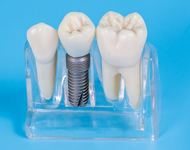Why Choose Royal West Dentistry for Your Dental Implants?