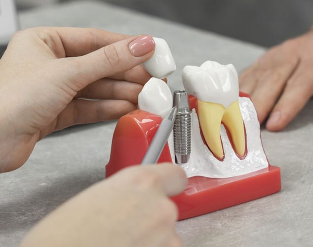 Single Tooth Implants: Procedure, Benefits, and Aftercare