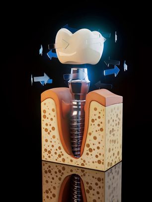 The Dental Implant Timeline: What Happens During Each Phase